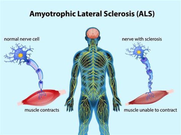 
James Yeager Illness: What Is ALS Disease? Symptoms And Health Update 